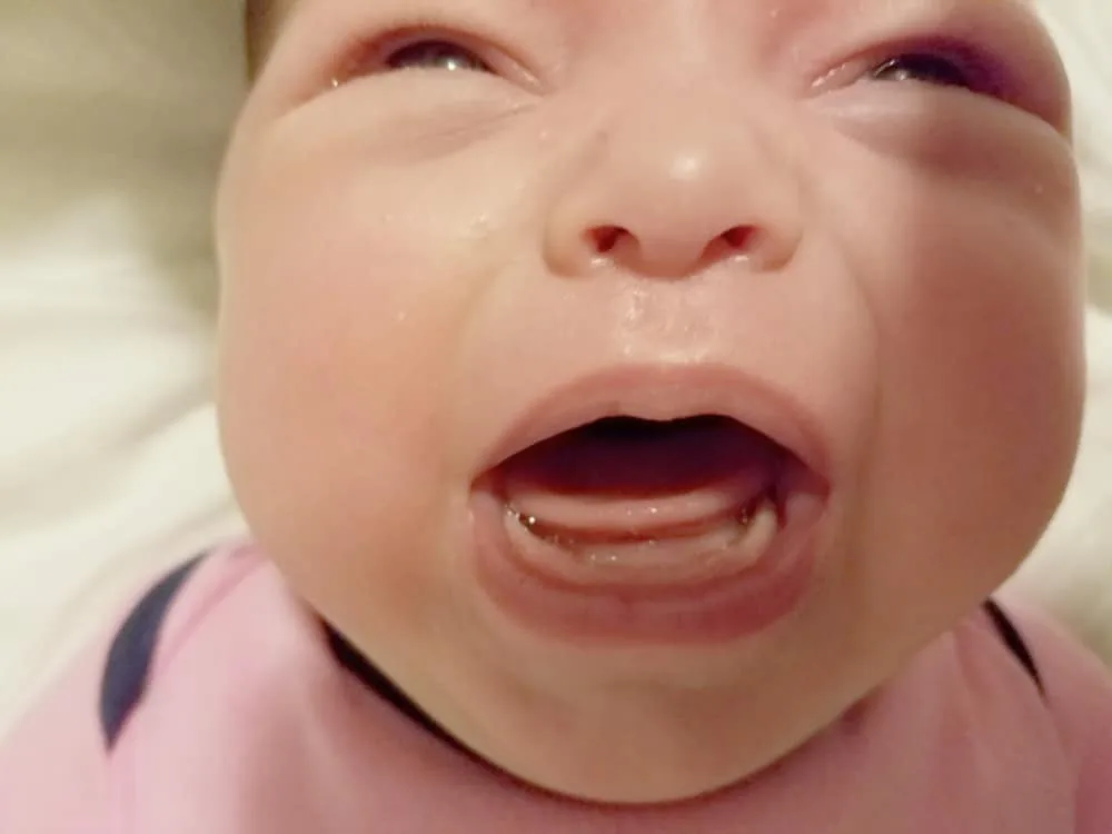 Breastfeeding a Tongue-Tied Baby - Posterior Tongue Tie