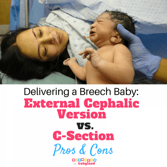 External Cephalic Version vs a C-section Pros and Cons