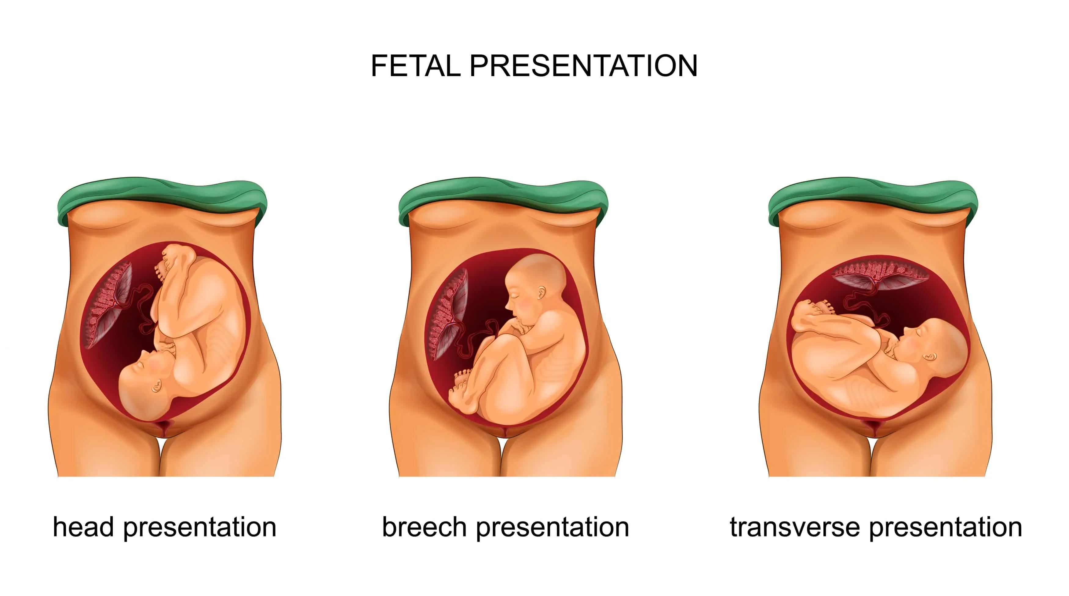 Breech Presentation - Transverse Presentation