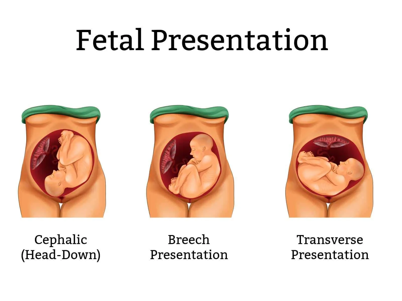 Fetal-Presentations-Breech-Baby-1