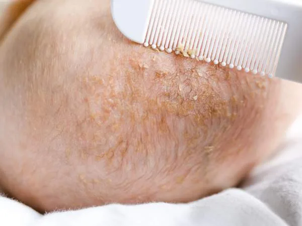 Cradle Cap - Comb (1)