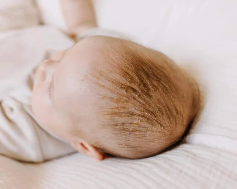 Cradle Cap Remedies (1)